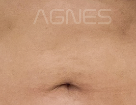 Agnes Ultra result — after