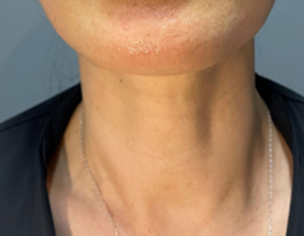Agnes Ultra result — after