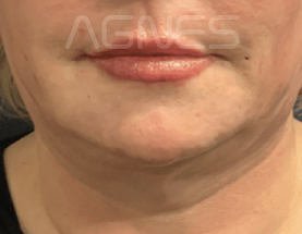 Agnes Ultra result — after