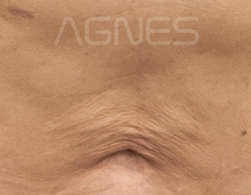 Agnes Ultra result — before