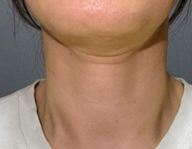 Agnes Ultra result — before