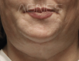 Agnes Ultra result — before
