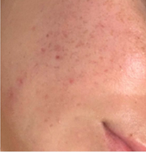 Solara Aevum skin treatment result — after