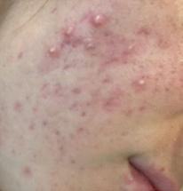 Solara Aevum skin treatment result — before