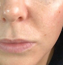 Solara Aevum skin treatment result — after