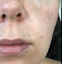 Solara Aevum skin treatment result — before